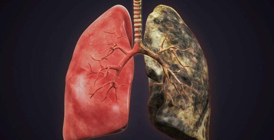 smoker's lungs and quitting smoking